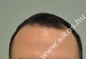 Hajbeültetés FUE módszerrel. 2000 graft, 4107 hajszál. Képek a műtét előtt  és 11 hónappal utána. 