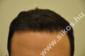 Hajbeültetés FUE módszerrel. 2000 graft, 4107 hajszál. Képek a műtét előtt  és 11 hónappal utána.